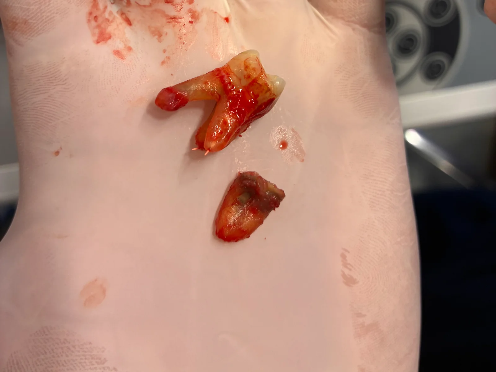 Two root-canal-treated teeth and fragments immediately after extraction